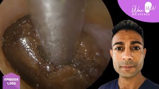 1,050 - Monumental Ear Wax Removal
