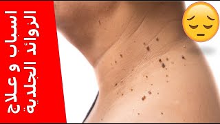 الزوائد الجلدية 🤔الزوائد اللحمية (الثآليل) الأسباب والأعراض والعلاج 👍👌💇