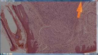 2016 2017 Elston Dermpath Ch 22