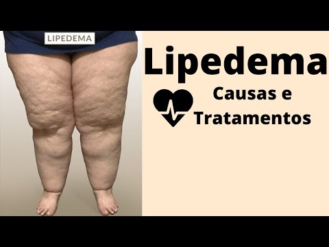 Lipedema: Causas e Tratamentos