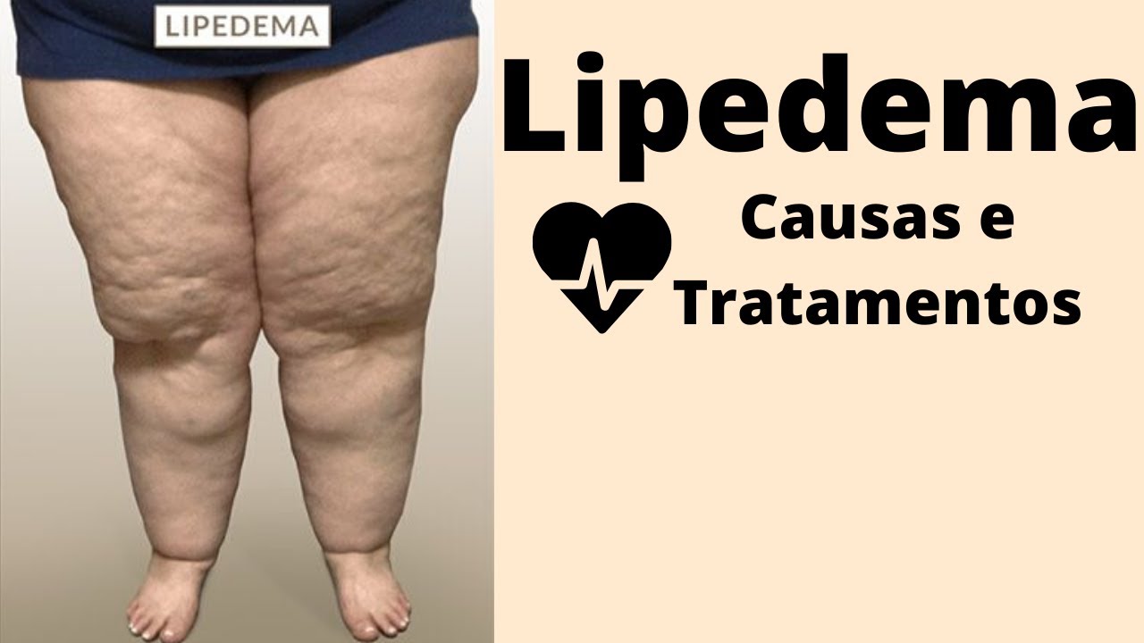 Lipedema: Causas e Tratamentos 