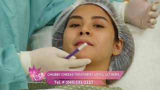 CHUBBY CHEEKS TREATMENT USING ULTHERA