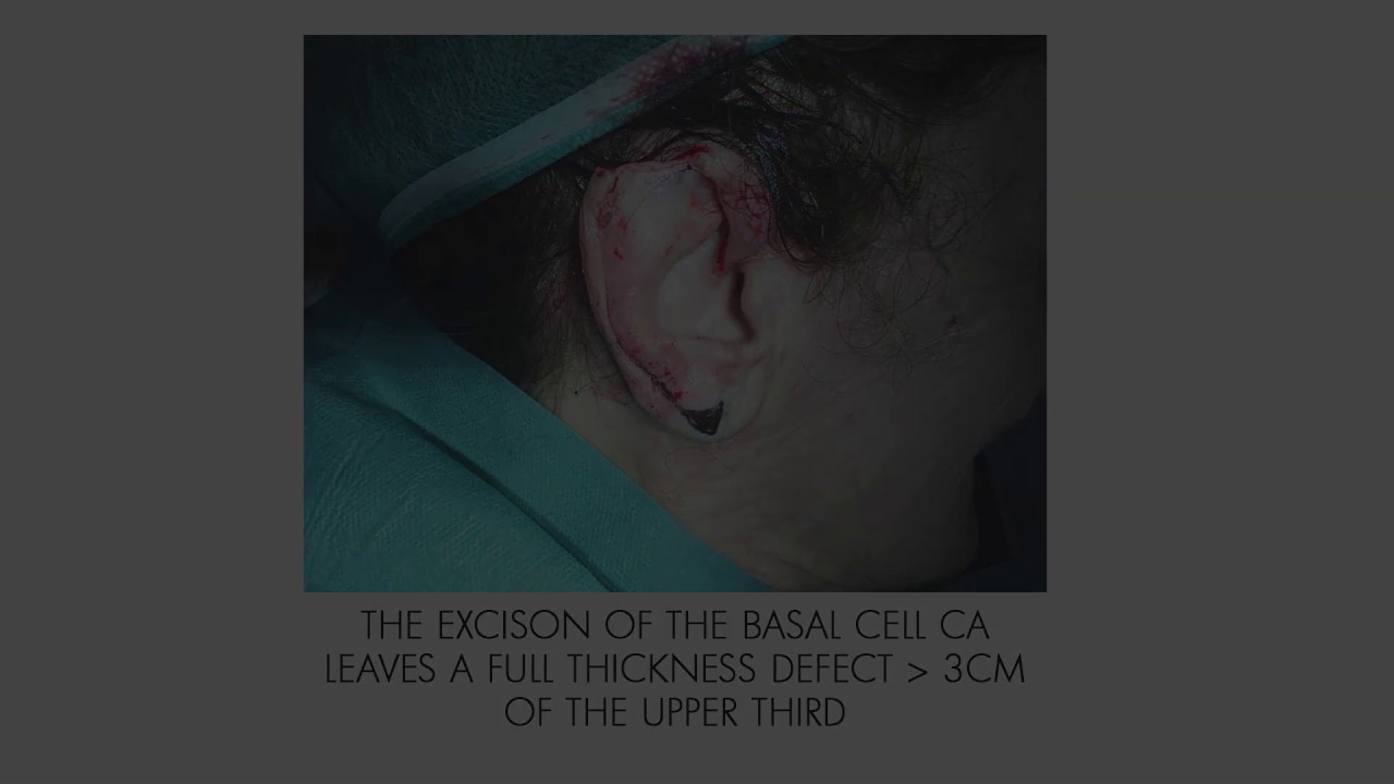 EXCISION BCC EAR RECONSTRUCTION ANTIABUCH HELICAL ADVANCEMENT, RHODES