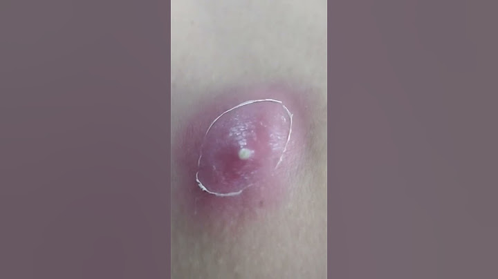 Drenagem de abscesso cutâneo #medicina #enfermagem #saude #cirurgiageral #doentes #tratamento