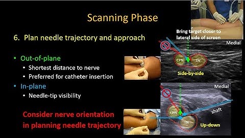 US-guided Popliteal Sciatic Nerve Block