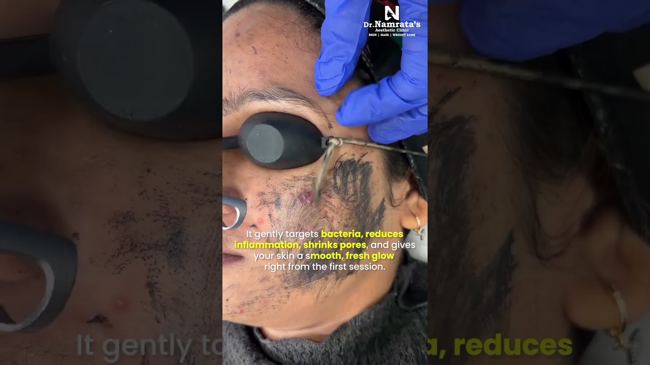 Carbon Laser Treatment for Acne & Open Pores | Clear, Smooth & Oil-Free Skin