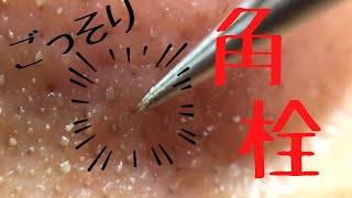 【角栓マニア】鼻の角栓ピンセットでたくさん抜いてみたよ。pimplepopping blackheads whiteheads