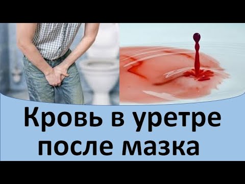 Кровь в уретре после мазка