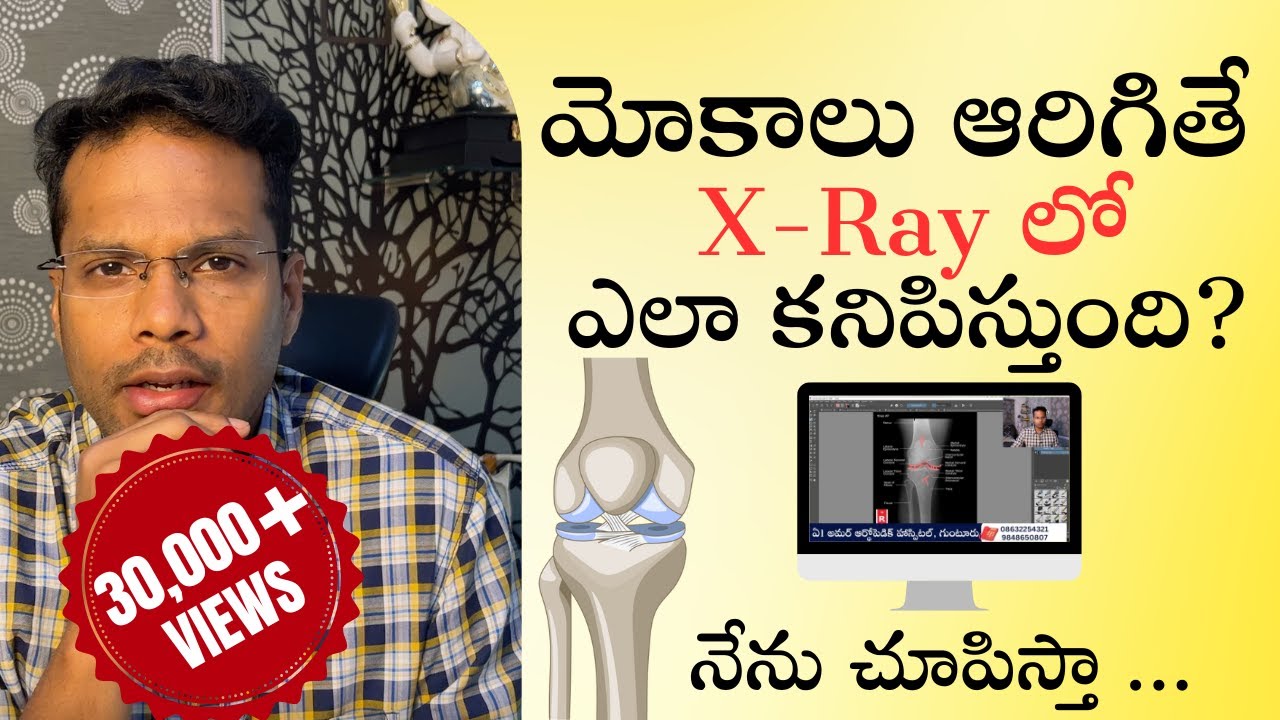 Osteoarthritis knee | Xray changes | Staging explained | Telugu | Dr Ramprasad Kancherla