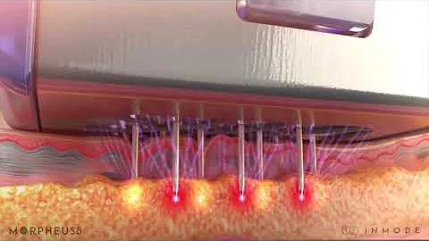 Morpheus8 Radiofrequency Microneedling