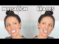 Braces or Invisalign? (Which is BETTER)