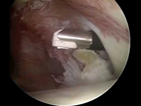 All-Arthroscopic Suprapectoral Long Head of Biceps Tendon Tenodesis With Interference...