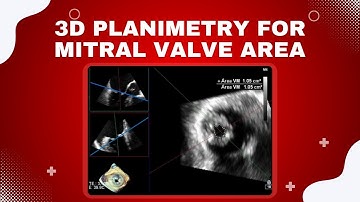 How to Perform 3D Planimetry for Mitral Valve Area in Mitral Stenosis (MS) -  (Echocardiography)