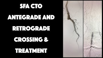 SFA CTO Antegrade and Retrograde Access for Crossing & Treatment