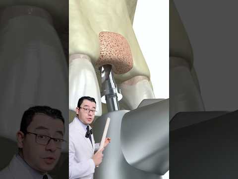 زراعة الاسنان