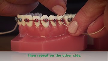 HOW TO FLOSS BRACES