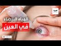 صباح العربية المياه البيضاء تغيير طبيعي في العين ويؤثر تدريجيا على الرؤية 