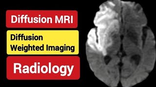 Diffusion MRI - DWI - RADIOLOGY