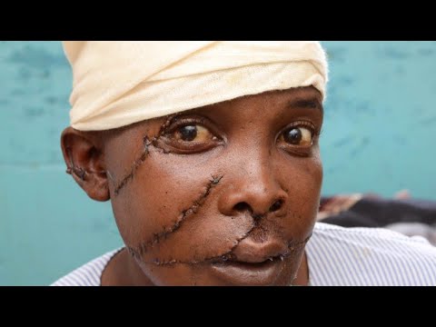 Video: Kirurgiliste Oskuste Väljaõppe Lünkade Kõrvaldamine Odavate Simulatsioonide Abil Tansaania Muhimbili ülikoolis