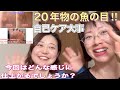 【魚の目処理】みんみん先生の20年間放置状態の魚の目。1回目ケア後は、自己ケアをしてもらい今回2回目でどこまで綺麗になったか⁈