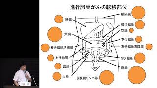 卵巣がん 進行卵巣がんの全てがわかる！