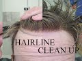 HAIR REPLACEMENT SYSTEM, BONFIRE SOOT DIRTIED MY NEW HAIRLINE....LACE FRONT CLEAN UP TUTORIAL
