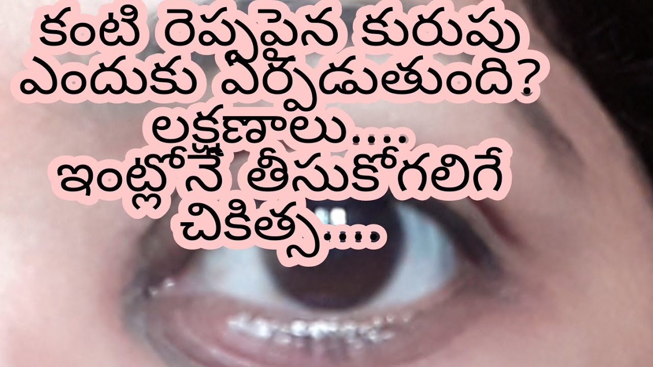 Eye stye(కంటి కురుపు ),reasons,symptoms and home remedy in teluguSuni
