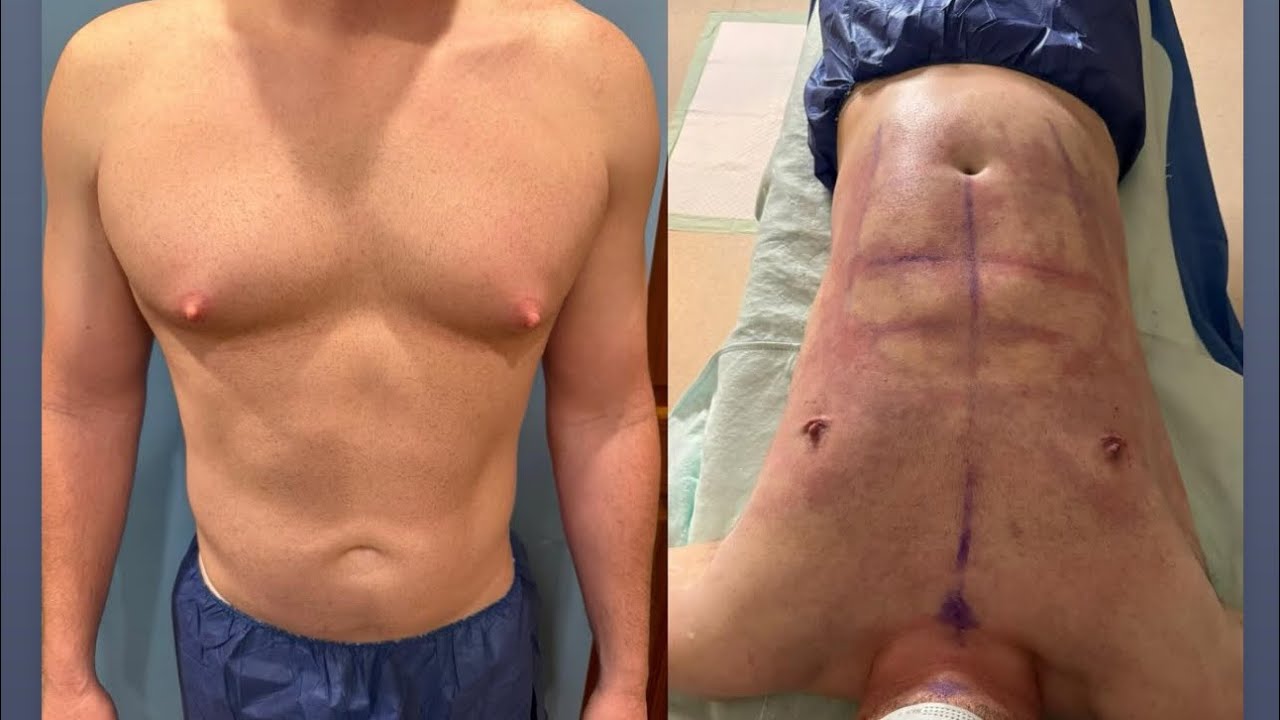 lebo-gyno-beyond-just-finished-a-amazing-case-of-gynecomastia-surgery