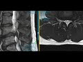 Case Review 7 - Stenosis &amp; Disc Herniation