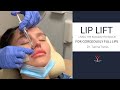 Achieving Fuller Lips: Expert Insights on Lip Filler Techniques