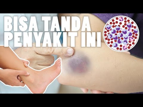 Video: Sianosis (bibir Dan Kulit Biru) - Penyebab, Ancaman Terhadap Kehidupan, Rawatan