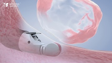 Introduction of EUS-FNB and EUS-FNA Needles
