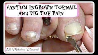 👣Ingrown Toenail Big Toe Pain Remedy Pedicure Tutorial 👣 👣Ingrown Toenail Big Toe Pain Remedy Pedicure Tutorial 👣