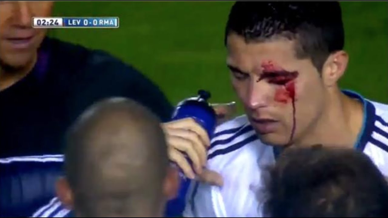 CRISTIANO Ronaldo Very Hard Eye Injury - Knock out golpe ...