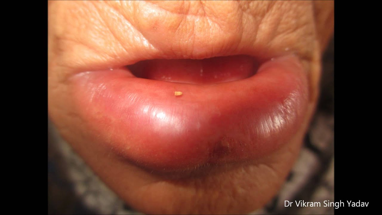 swollen upper lips causes