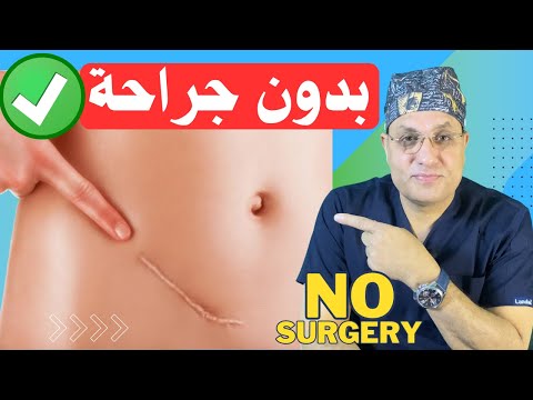 علاج التهاب الزائدة الدودية الحاد| متى يمكن العلاج بدون جراحة؟