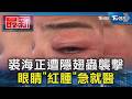 裘海正遭隱翅蟲襲擊 眼睛「紅腫」急就醫｜TVBS新聞 @TVBSNEWS01