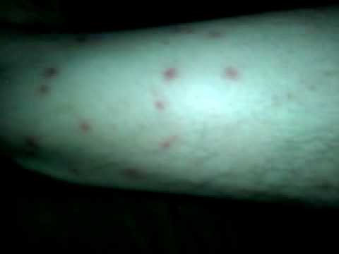 Chiggers Attacked on the 4th of July - YouTube