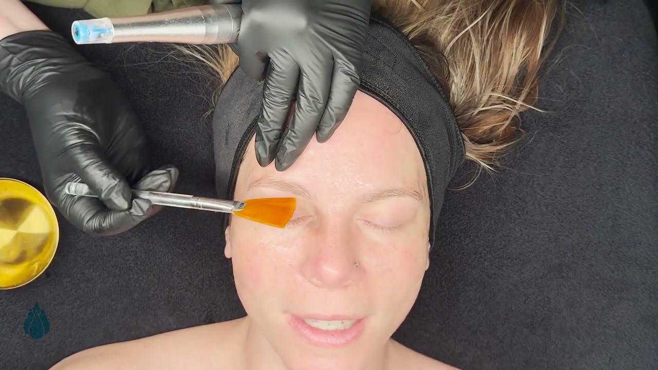 Chemical Peels and NanoInfusion with Rezenerate & Linder Health