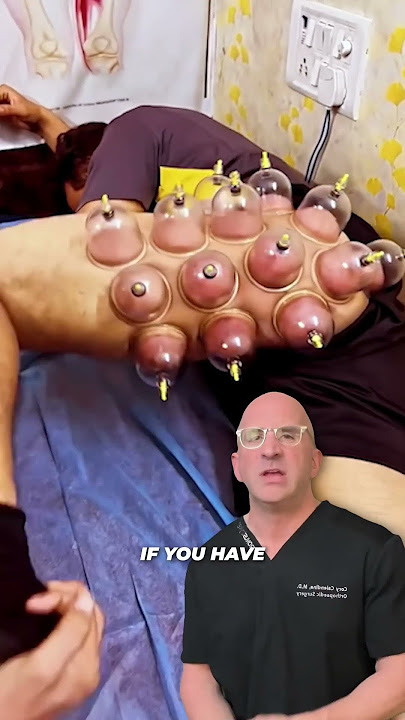 Cupping Therapy - Pain Relief or Nonsense⁉️ #shorts