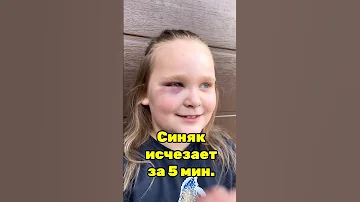 Как избавиться от любого синяка за 5 минут