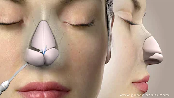 ¿Es permanente la operación de nariz?