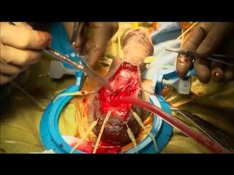 Penile Implant Surgery: Erectile Dysfunction Treatment Full Video