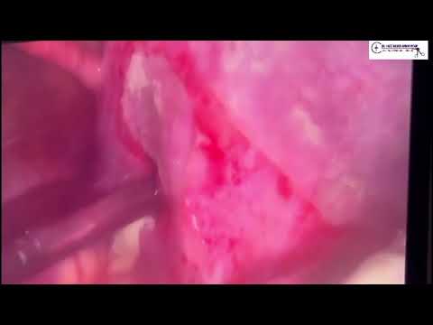 Laparoscopic appendectomy for Perforated gangrenous appendix