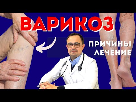 Варикоз. Вздутые вены. Причины и лечение варикоза и хронической венозной недостаточности.