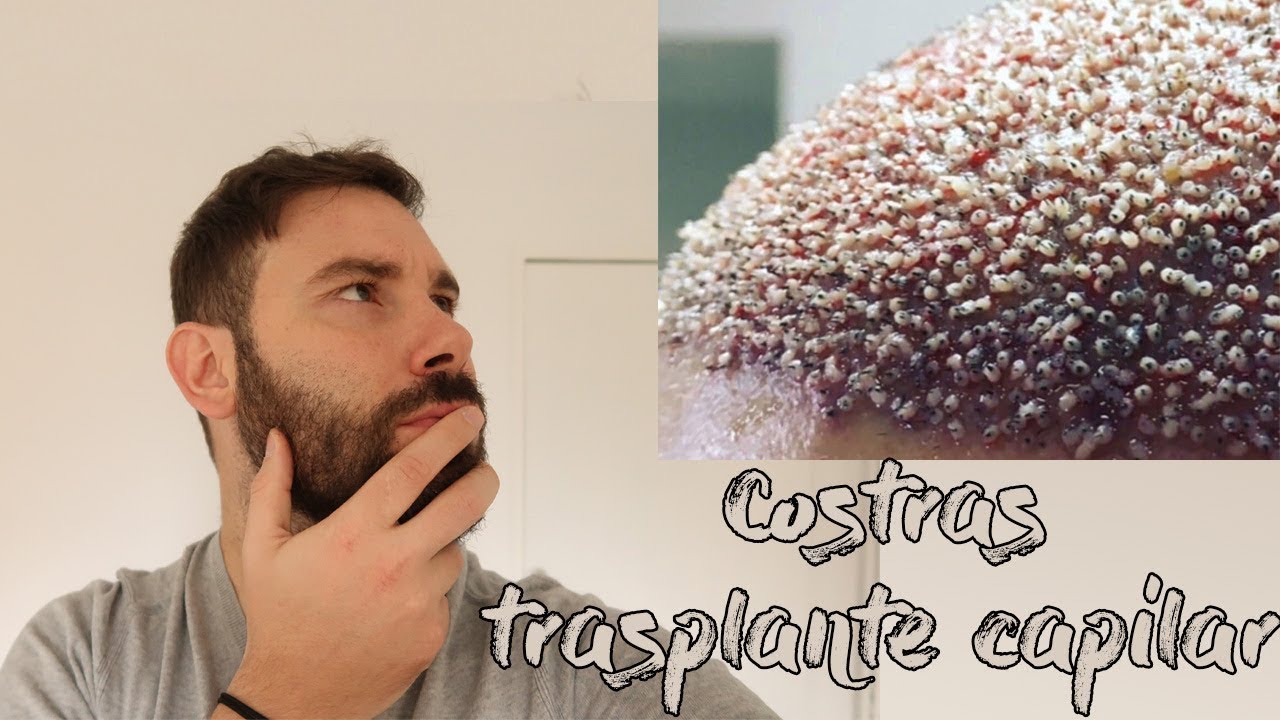 ¿Cuándo se CAEN las COSTRAS tras un TRASPLANTE CAPILAR? - YouTube