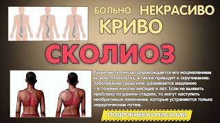 СКОЛИОЗ