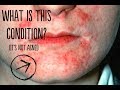 What Is This Skin Condition? (& How Do You Treat It?)