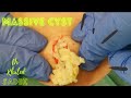 Massive Back Cyst. Dr Khaled Sadek. LipomaCyst.com