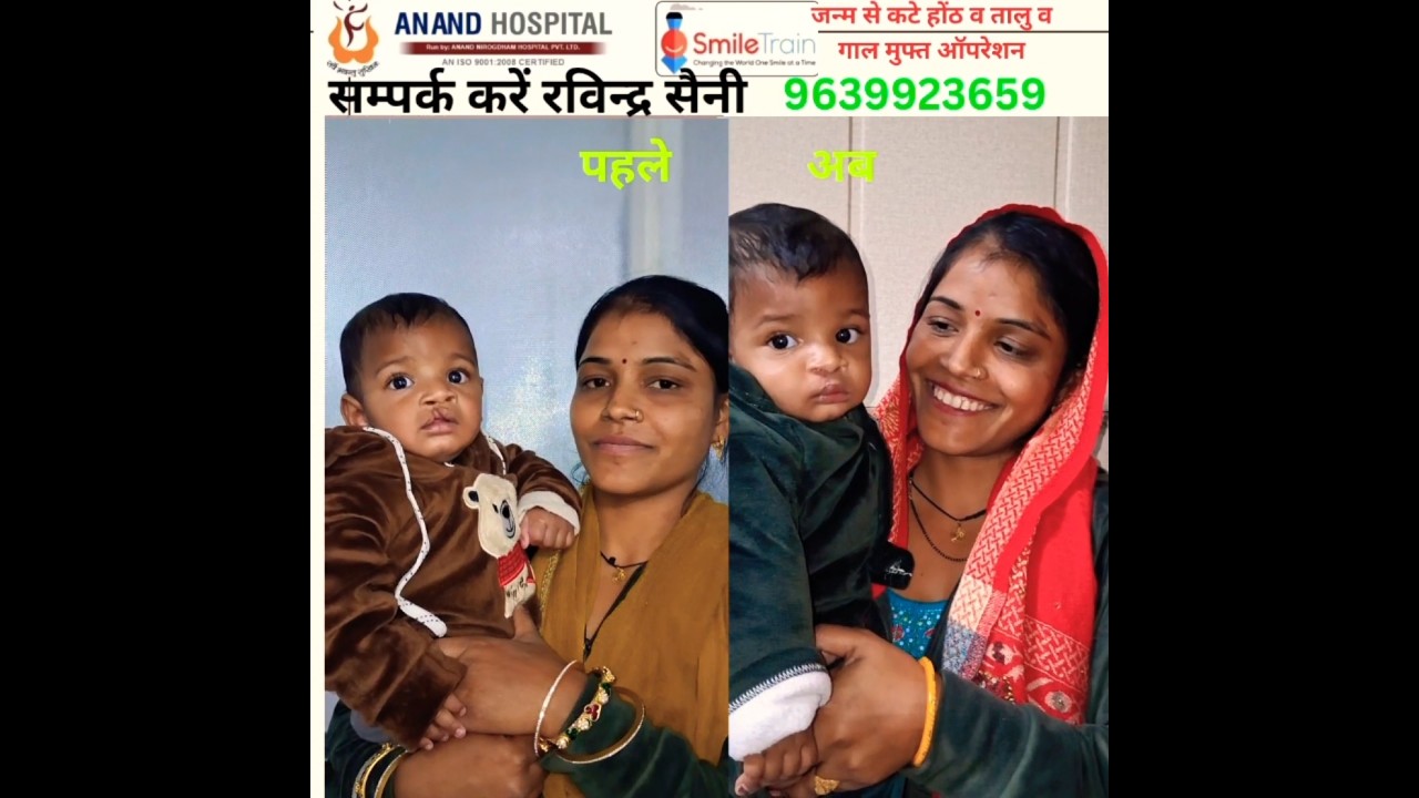 !!जन्म से कटे होंठ व तालु मुफ्त ऑपरेशन 
